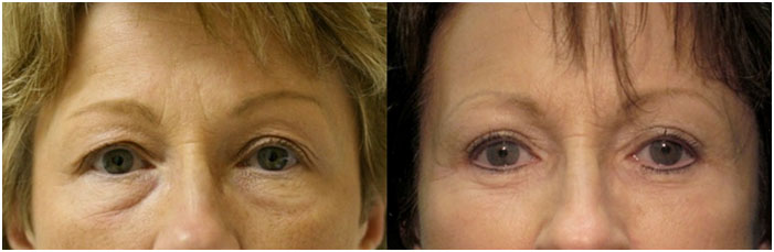 blephraoplastie photos avant apres