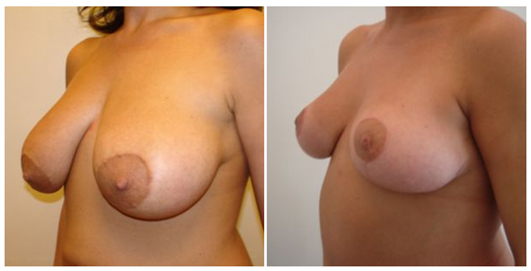 photos avant apres lifting seins