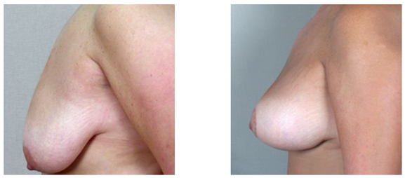 lifting seins photos