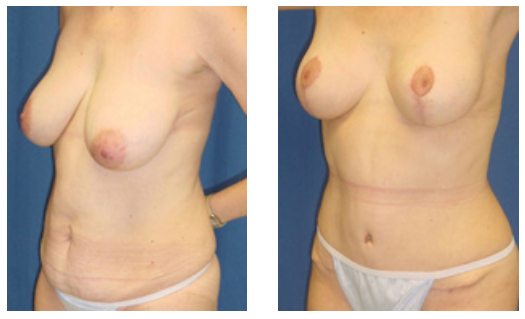 lifting seins