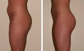 injection graisse fesses