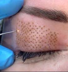 blepharoplastie laser