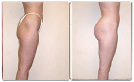 sculptra avant apres