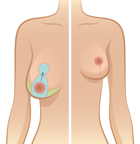 Asymetrie des seins : causes et solutions - clinique Hannibal Tunisie